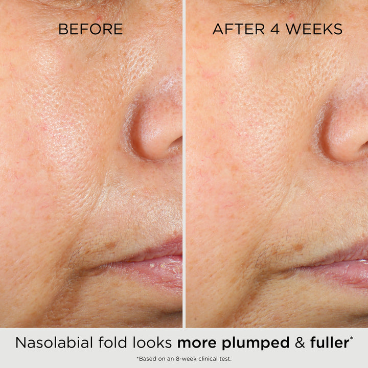 Before and after 4 weeks, Nasolabial fold looks more plumped and fuller* *Based on an 8-week clinical test.