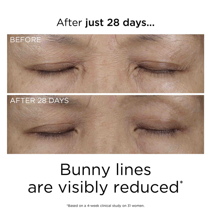 After just 28 days, bunny lines are visibly reduced* *Based on a 4-week clinical study on 31 women.